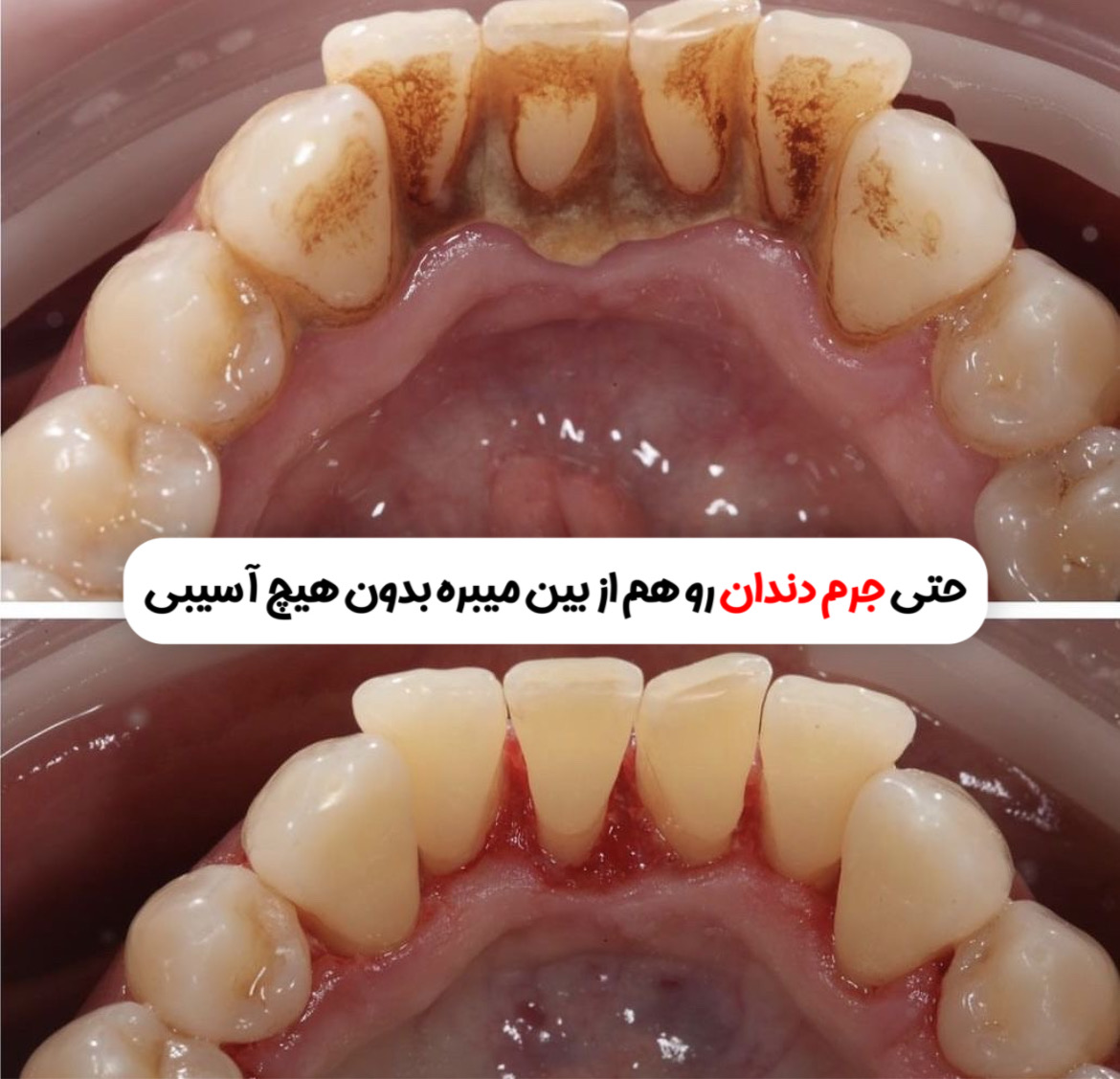 قطره سفید کننده دندان لانبنا